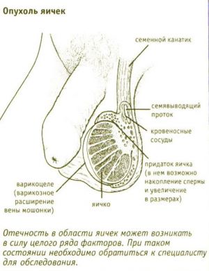 Опухоли яичек